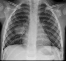 asbestosdisease